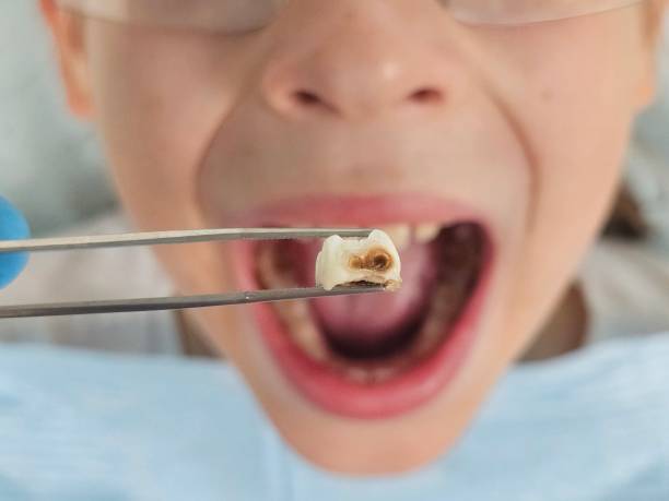 Best Broken or Chipped Tooth Repair in Heber Overgaard, AZ